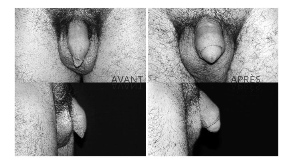 Circoncision avant/après