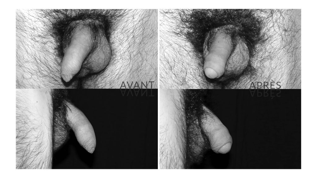 Circoncision avant/après